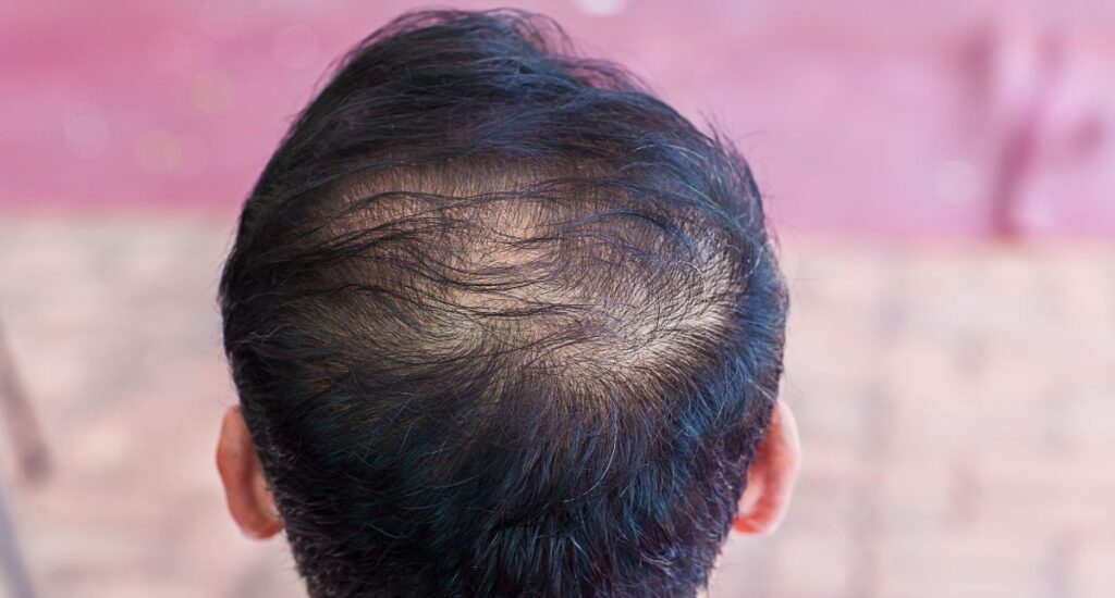 Hair thinning due to a hormonal imbalance