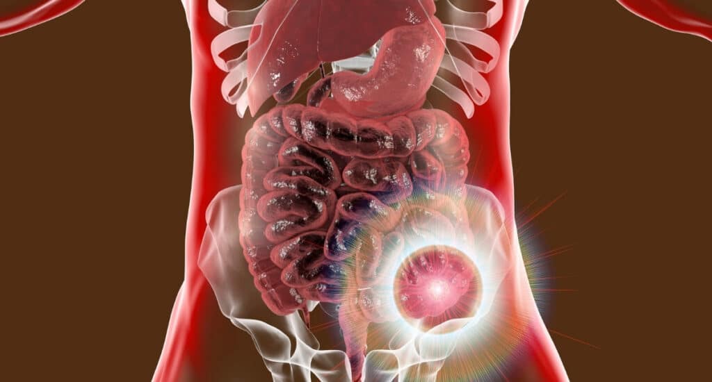Preventative Health Screening for Colon Cancer